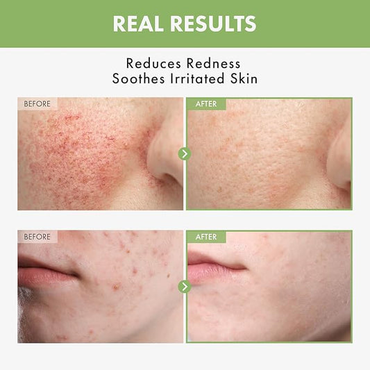 TOSOWOONG Heartleaf Face Toner with 970,200ppm Heartleaf Water, Centella, Hyaluronic Acid, Witch Hazel, Trouble Care, Acne-Prone, Calming, Hydrating, Purifying, Korean Skin Care, 250ml, 8.45 fl.oz.