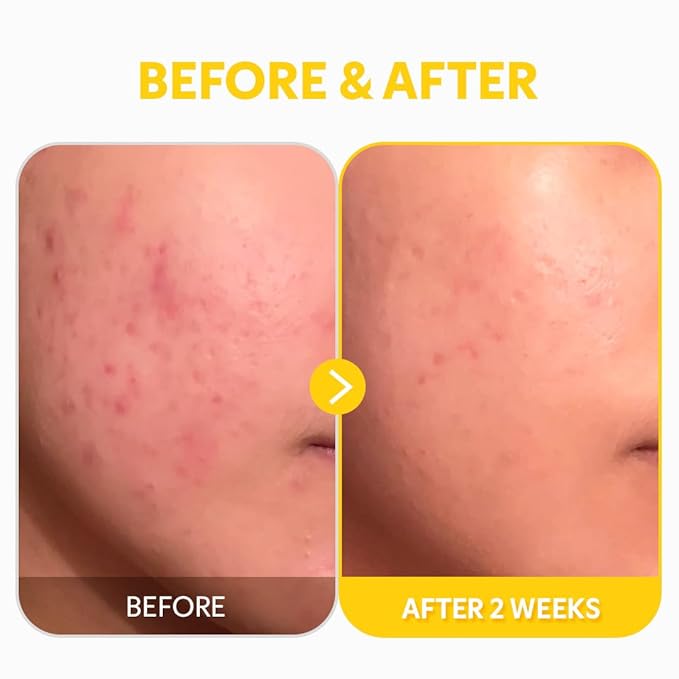 TIRTIR Pure Vitamin C 24% Face Serum – Dark Spot Remover for Sensitive Skin with Collagen Anti Aging Even out Skin Tone Non irritation tested, Wrkinkles, Korean Mild Vita C Facial Serum 1.01 Fl Oz