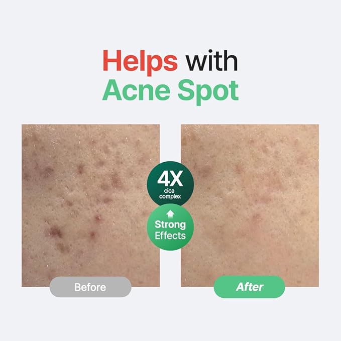 PURITO Centella Unscented Serum, 34,860 ppm Centella, Facial Serum for Sensitive Skin & Acne-Prone Skin, Soothing Serum, Vegan & Cruelty-Free, Korean Skincare, 2 fl.oz / 60ml