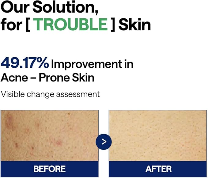 MEDIHEAL Teatree Trouble Facial Toner Pads with Tea Tree & Lactobacillus - Calming & Soothing for Sensitive & Acne Prone Skin - Vegan Face Gauze, 100 Pads