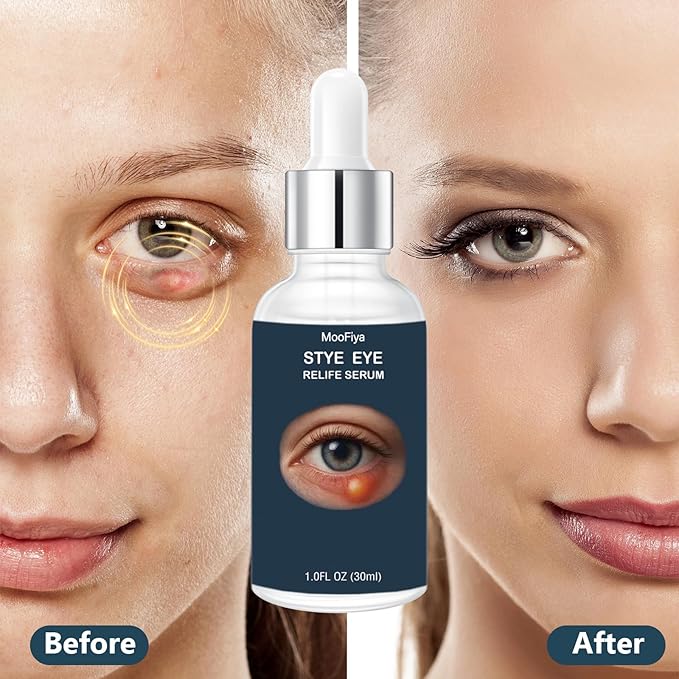 Stye Eye Treatment, Eye Reflief Serum for Styes and Chalazions, Non-Irritating, Eyelid Comfort Serum, Plant-based Formula, , (30ML-1 Fl Oz)